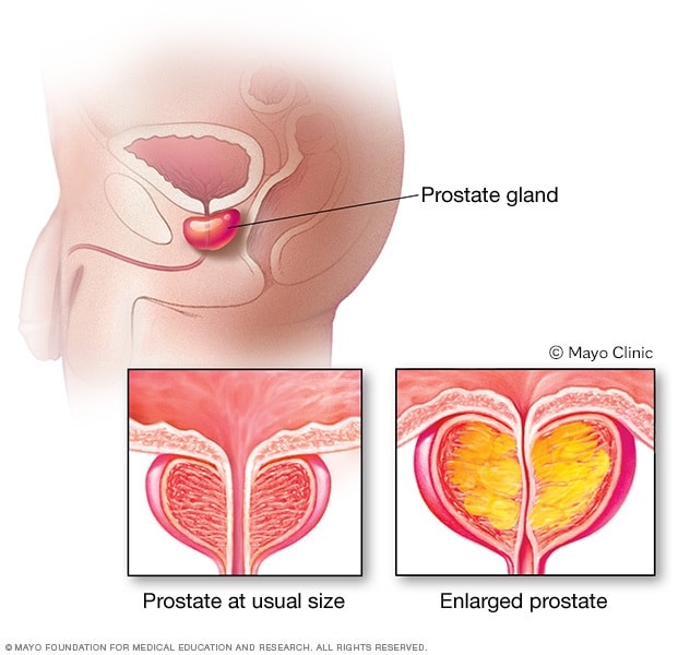 Cialis Y Prostata