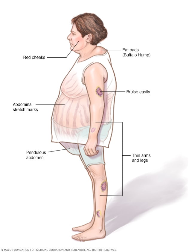 Image showing Cushing syndrome 
