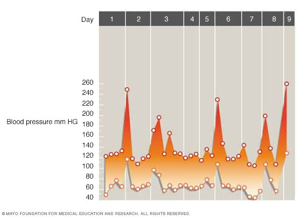 Graph showing fluctuations in blood pressure caused by a pheochromocytoma 