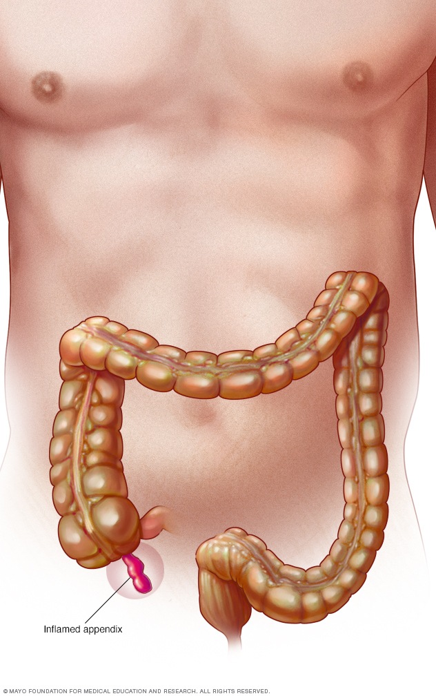 Illustration showing inflamed appendix 