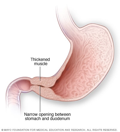 Illustration of thickened pylorus 
