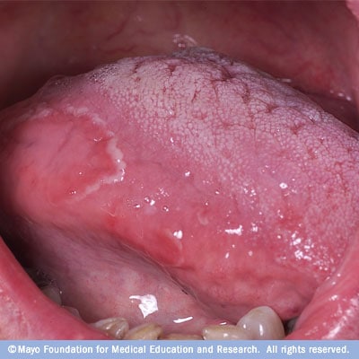 Geographic Tongue — NEJM