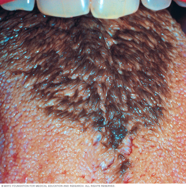 black hairy tongue is caused by an overgrowth of dead skin cells ...
