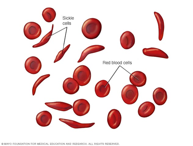 Illustration of normal red blood cells and sickle cells 