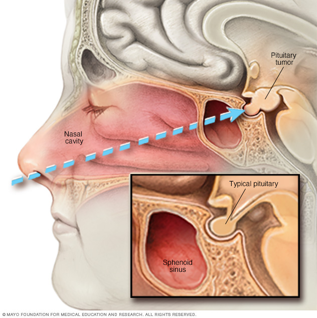 Medicinal drug for sinus pressure comfort fungal sinus infection thrush