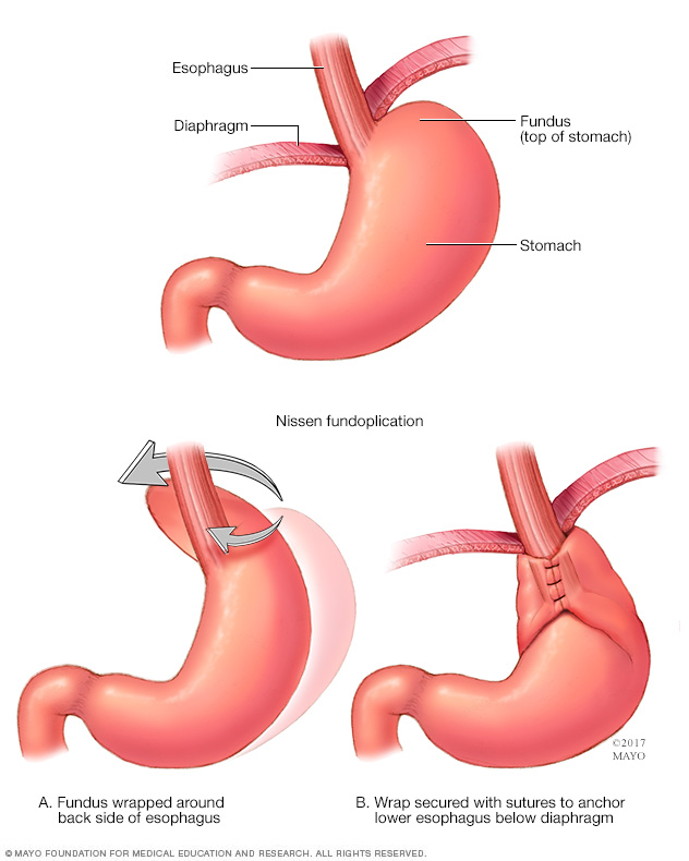 Illustration showing Nissen fundoplication