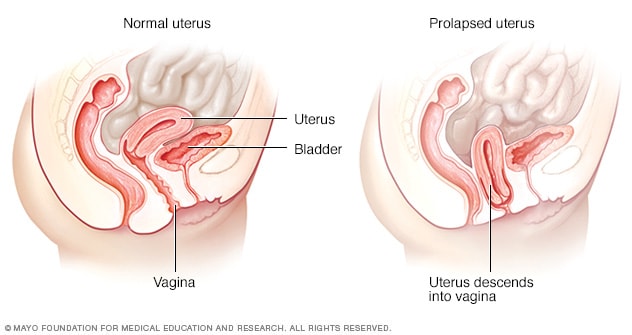 Illustration showing normal uterus and prolapsed uterus
