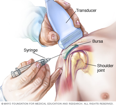 Ultrasound guided steroid injection shoulder