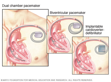 cardiac defibrillator vs pacemaker