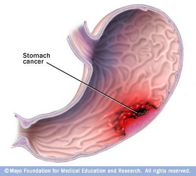 Illustration of stomach cancer 
