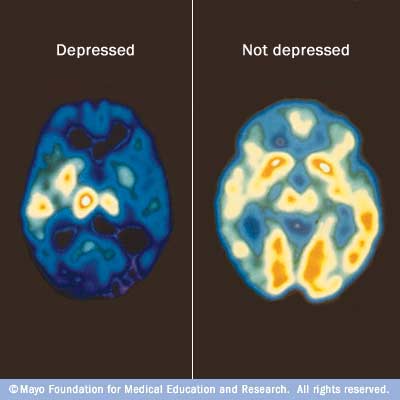 my00238_im00356_c7_pet_depressionthu_jpg.png (400×400)