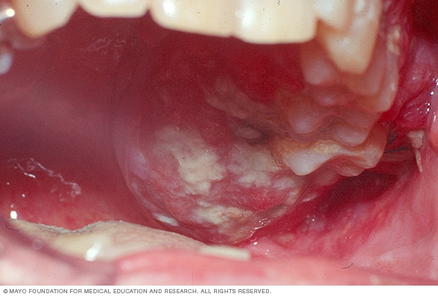 mouth cancer images