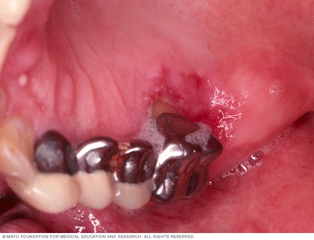 Pictures of mouth cancer | Cancer Research UK