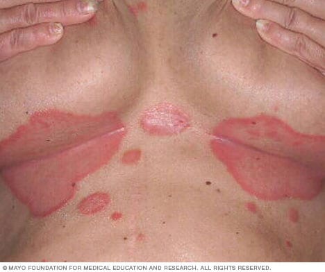 Pictures of Skin Rashes - Skin Rash ... - Healthy-skincare.com