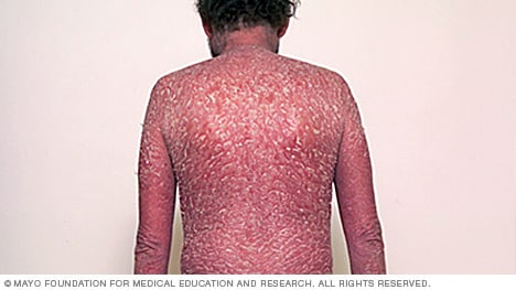 skin rash diseases #10
