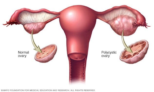 Illustration showing normal ovary and polycystic ovary 