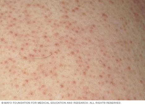 what causes keratosis pilaris