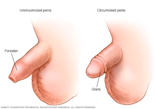Illustration of penis before and after circumcision 
