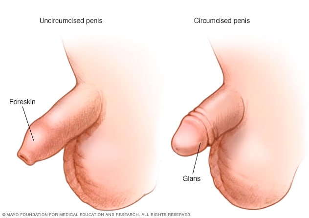 Illustration of penis before and after circumcision 