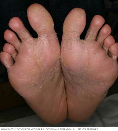 Ring Of Blisters On Hands And Feet 79
