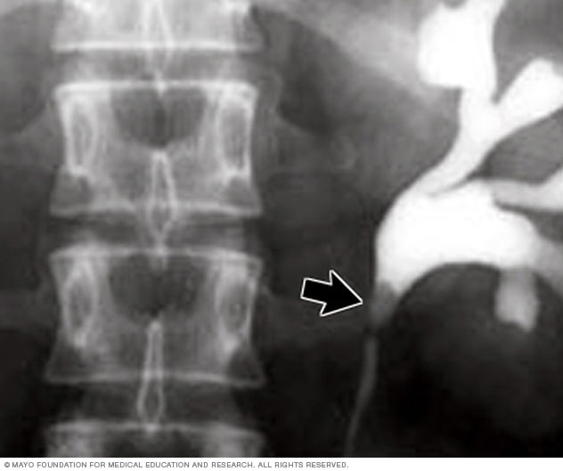 Xray image of kidney stone Mayo Clinic
