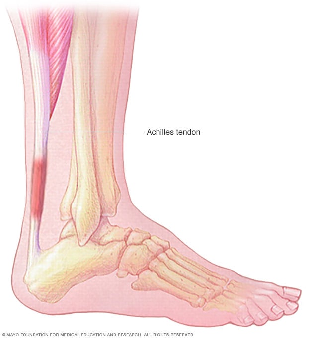 Illustration showing Achilles tendinitis 