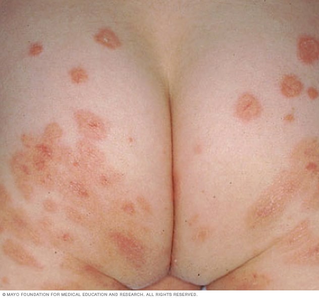 Impetigo Causes, Symptoms, Treatments, Prevention