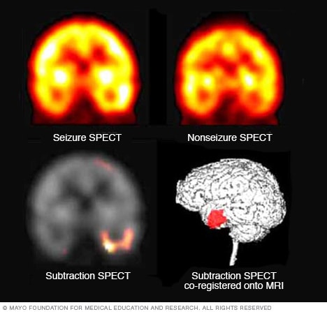 Pinpointing seizure location