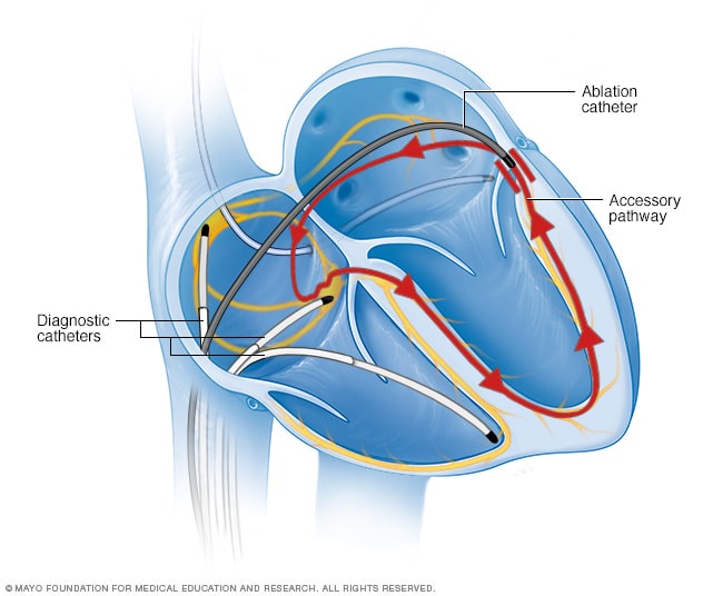 Illustration showing cardiac catheter ablation