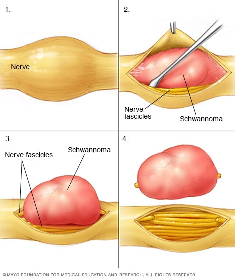 Neurofibromatosis: Neurofibromas Picture Image on ...