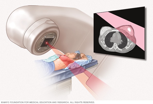 Illustration of radiation therapy for breast cancer 