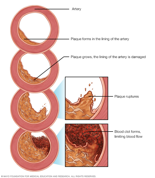Illustration showing development of atherosclerosis 