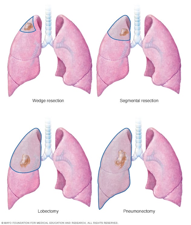 Illustration of lung cancer surgery