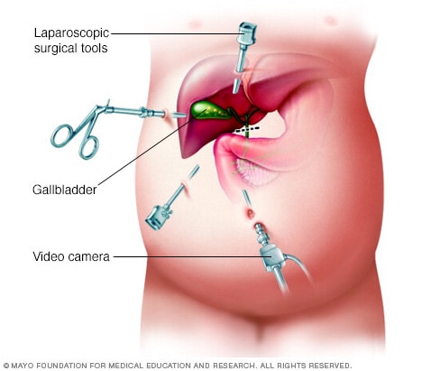 Image showing laparoscopic cholecystectomy