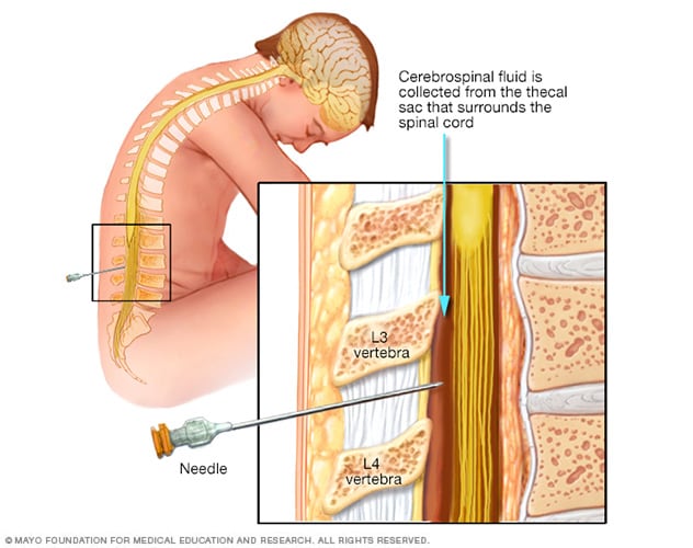 Lumbar puncture (spinal tap) 