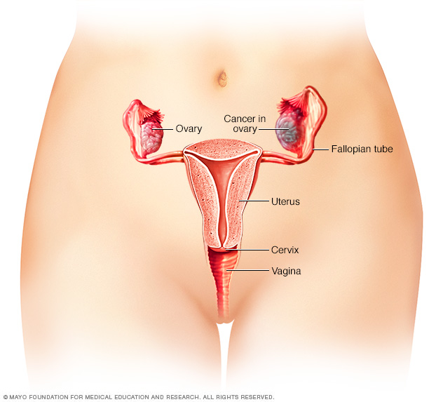 Illustration of ovarian cancer 