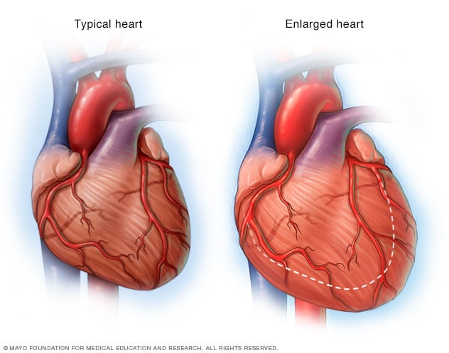 Illustration of an enlarged heart