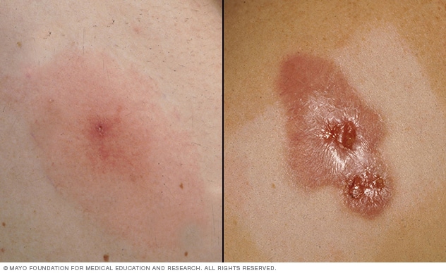 Photos of two staph infections: one minor, and one serious
