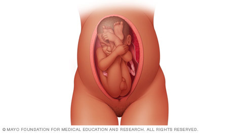 Illustration of baby in the buttocks-first position