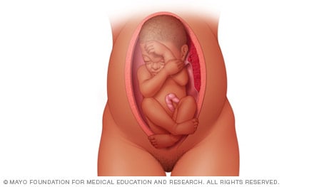 Illustration of baby in the feet-first position