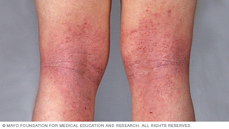 Red Skin Blotches on the Ankles | LIVESTRONG.COM