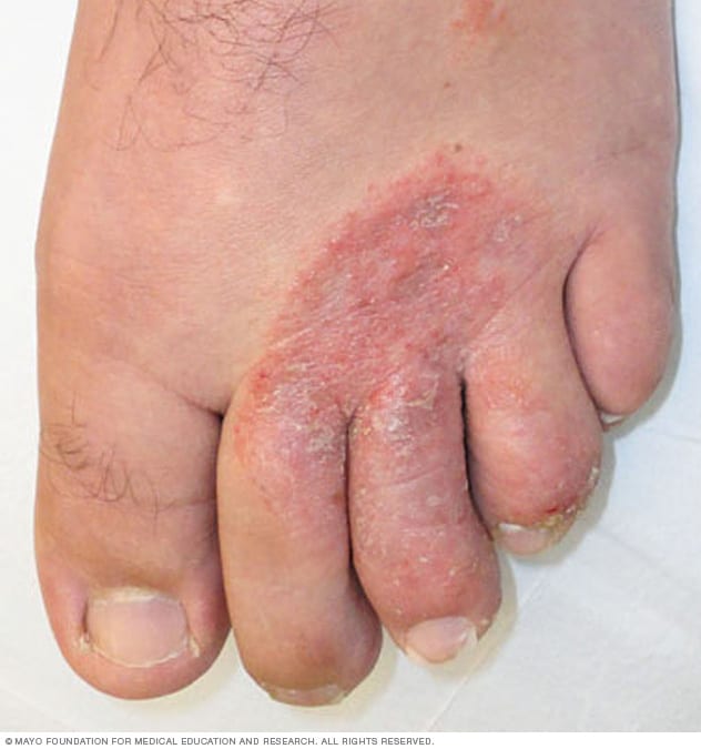 Foot Rash: Causes, Symptoms & Treatment