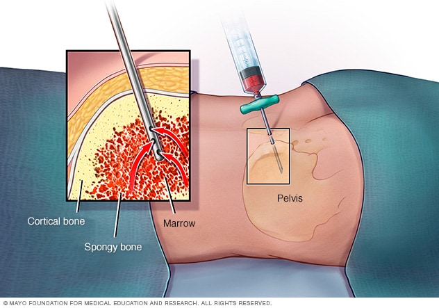 Illustration showing a needle suctioning out liquid bone marrow from hipbone