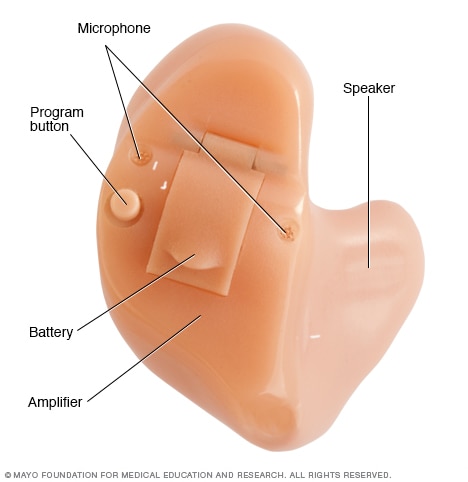 Hearing aid parts - Mayo Clinic