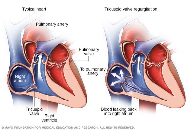 Overview - Tricuspid valve regurgitation - Mayo Clinic