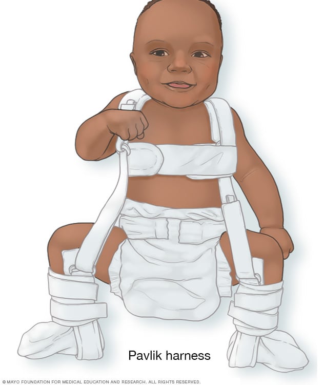 hip dysplasia image gallery hip dysplasia treatment hip dysplasia image gallery hip dysplasia treatment