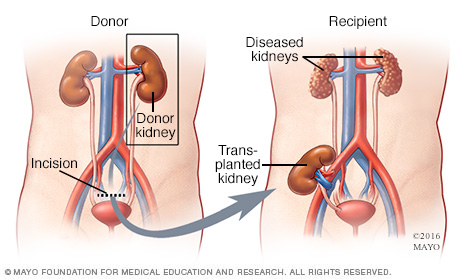 dialysis opportunity treatment