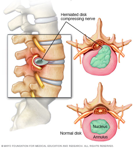 Image result for herniated disc