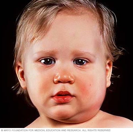 Fotografía de un niño con papera
