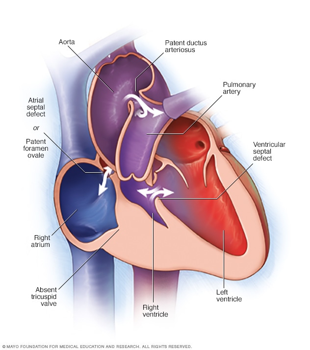 Tricuspid atresia - Symptoms and causes - Mayo Clinic